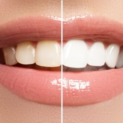 Ultra White Glow (80 Minutes) –  For deeper, longer-lasting whitening.